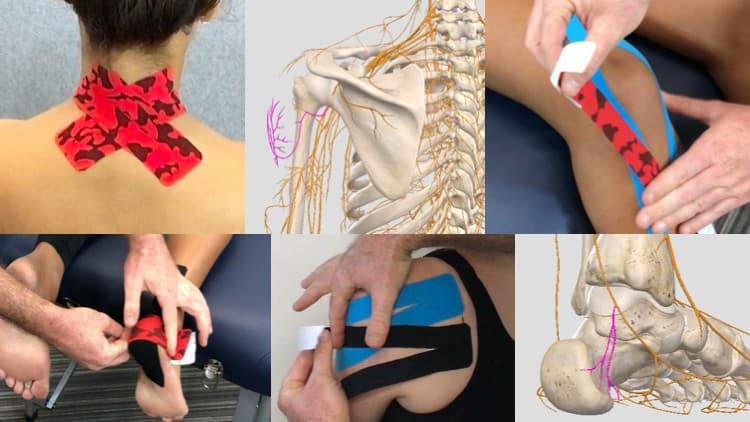 Kinesiology Taping - A Cutaneous Nervous System Approach