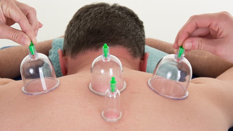 Cupping Therapy for Pain Relief & Trigger Points | 5 CEU